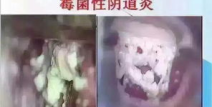 滴虫性阴炎的主要症状,瘙痒、疼痛与白带异常的困扰